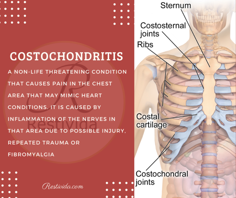 Costochondritis